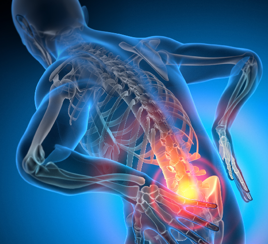 digital graphic of spine anatomy radiating pain