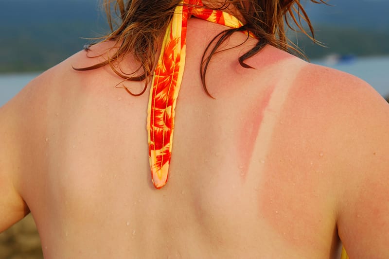 women in swimsuit's sunburn tan lines