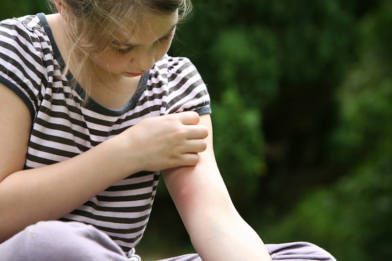 young girl scratches bug bites on her arm