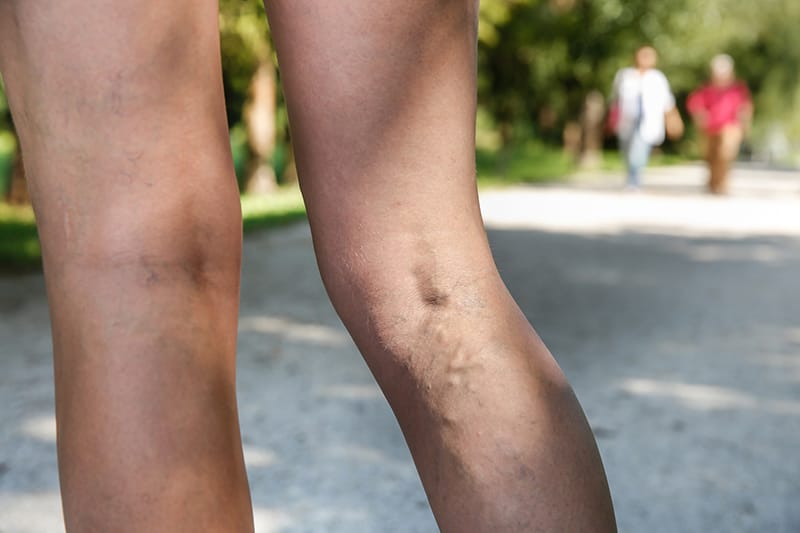 person with veins and blood clots showing on back of leg